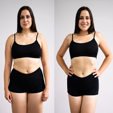Tummy Tuck Before And After Results